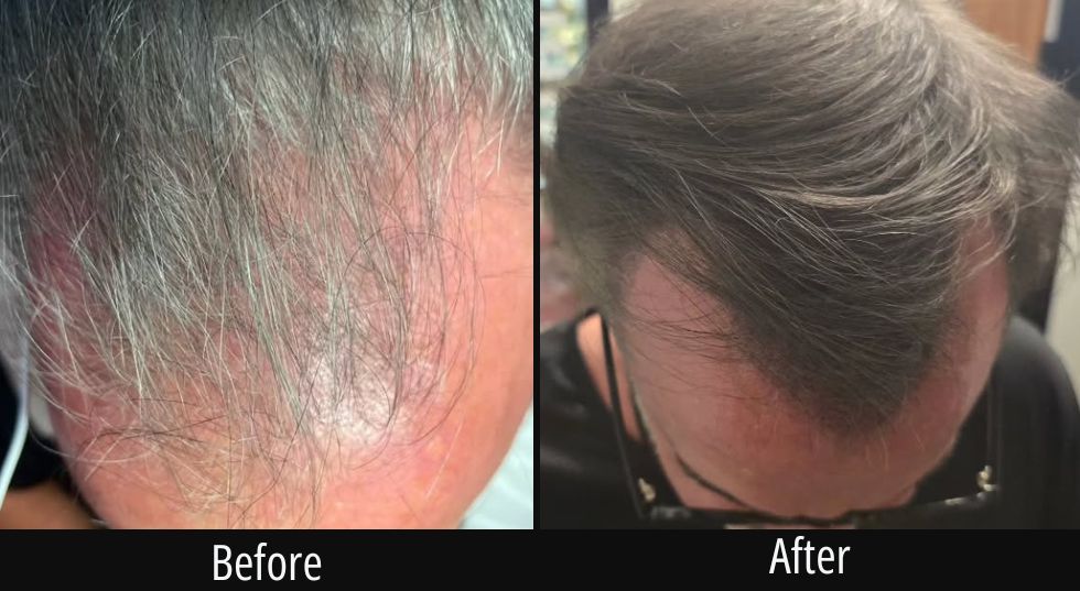Before and after scalp treatment showing improved hair coverage and color on back of head