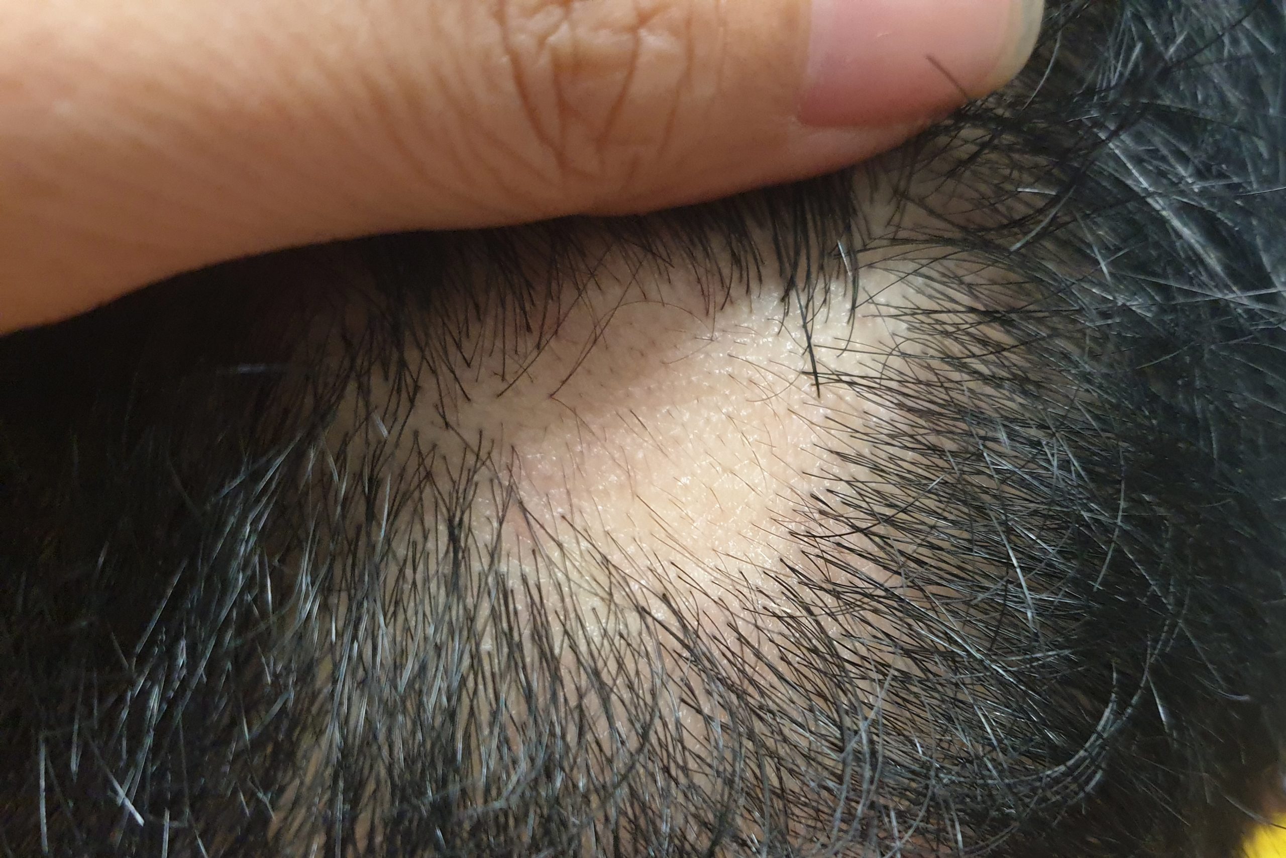 Finger pointing to scalp area showing hair loss and visible skin