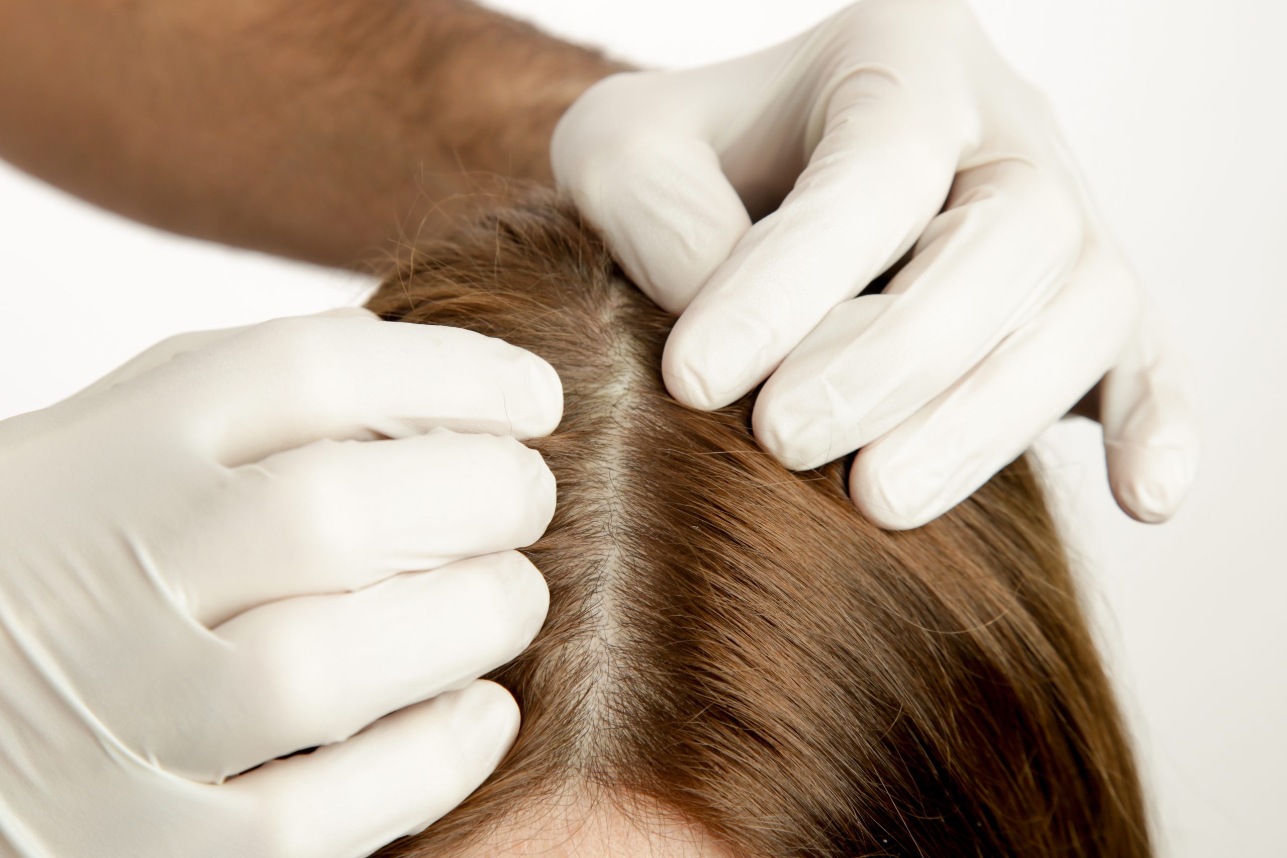Practitioner in latex gloves examining scalp and hair roots closely
