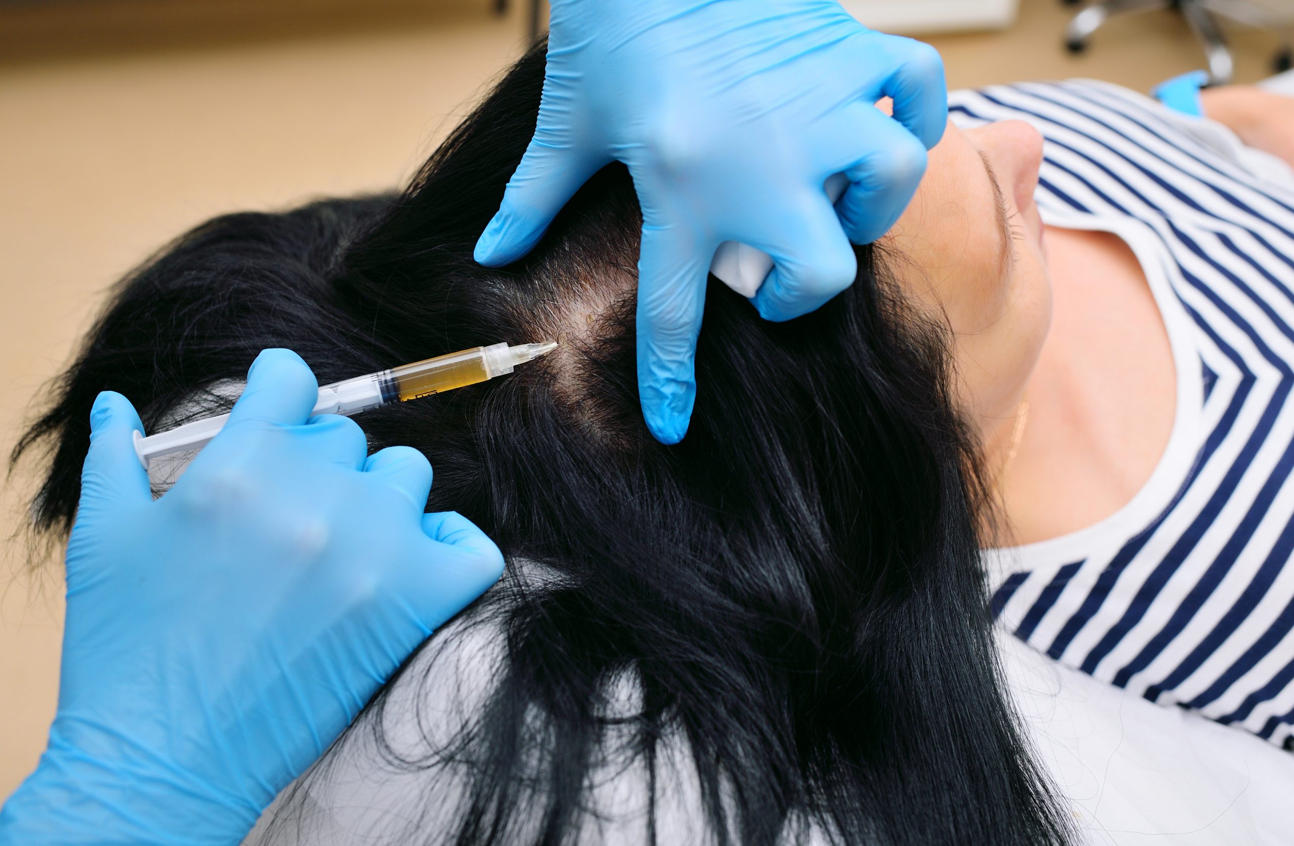 Practitioner in blue gloves injecting treatment into patient's scalp