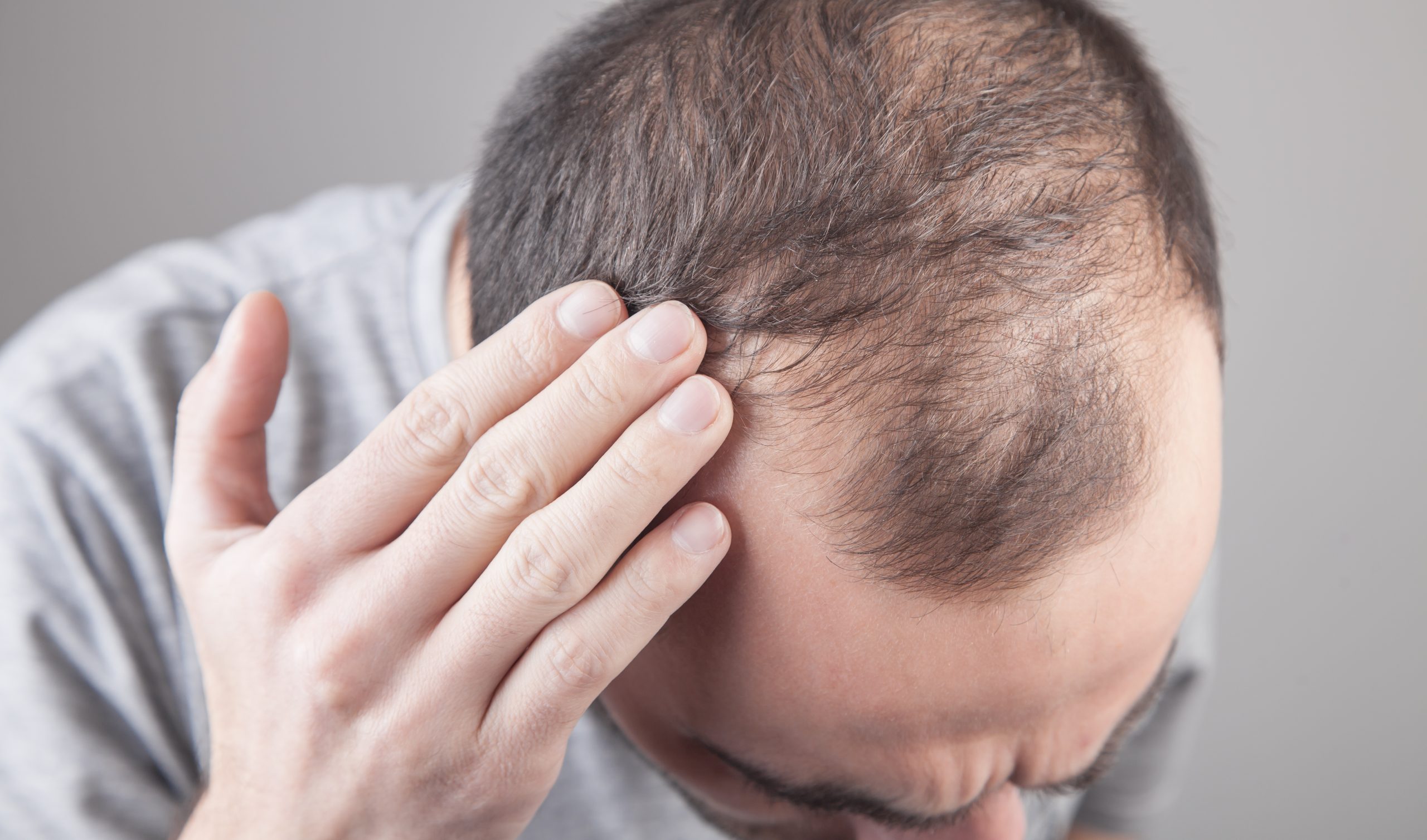 Man examining his scalp with hand showing receding hairline and thinning