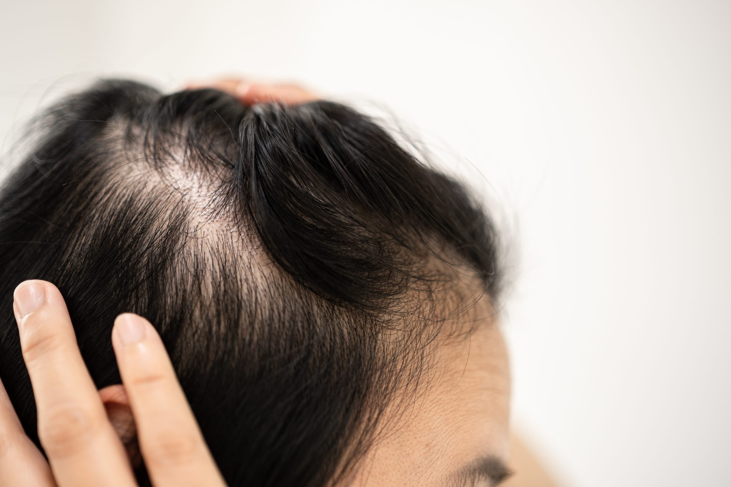 Close-up of person's hand on scalp showing thinning hair and exposed skin