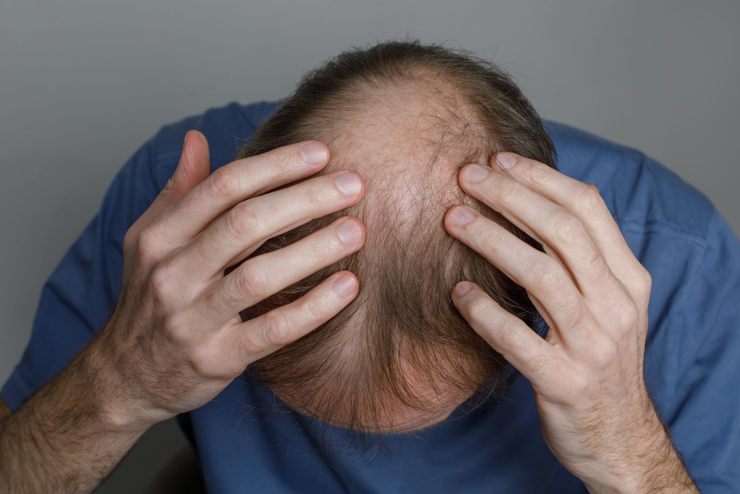 Man in blue shirt holding head with both hands, displaying receding hairline