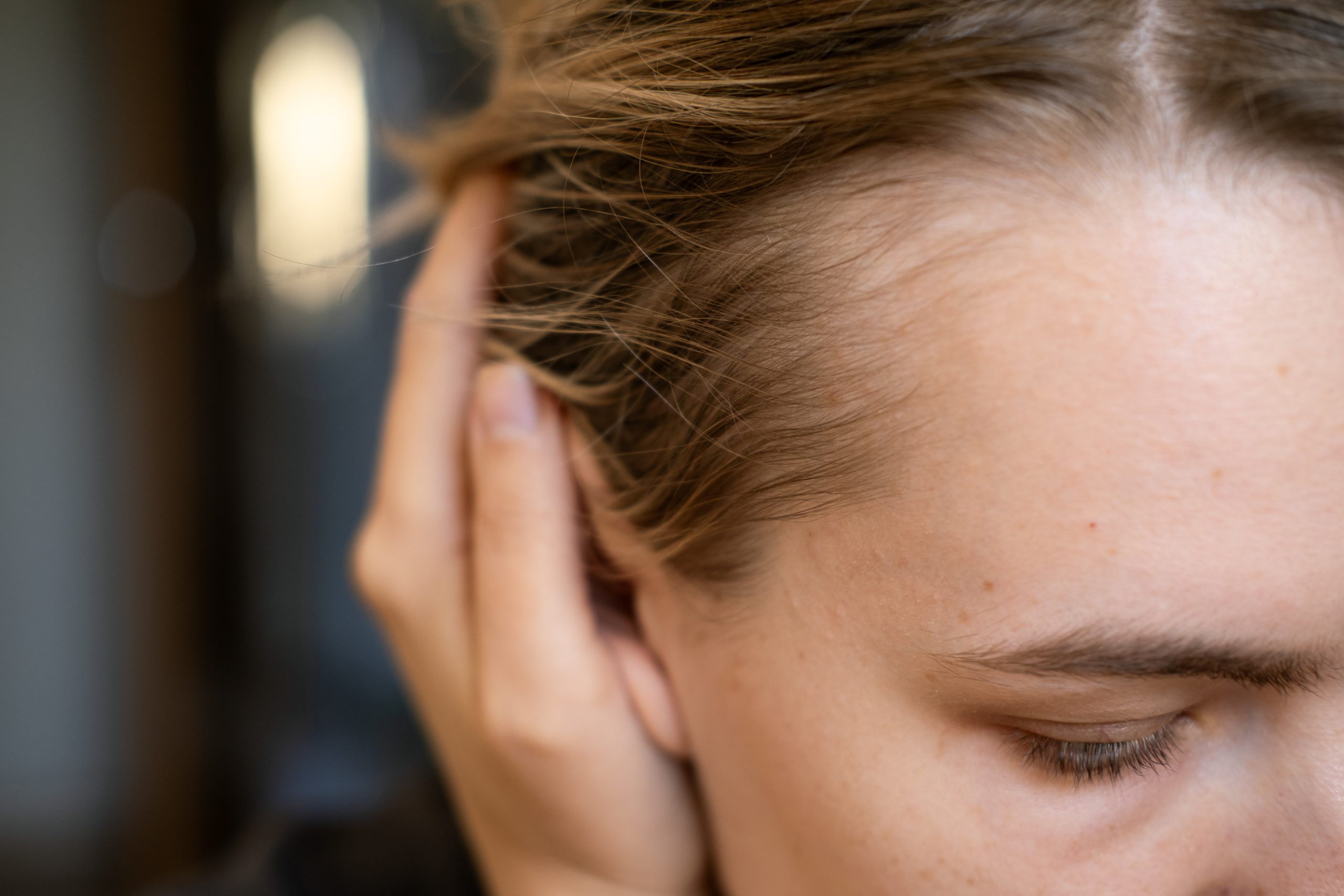 Woman with receding hairline at temple area