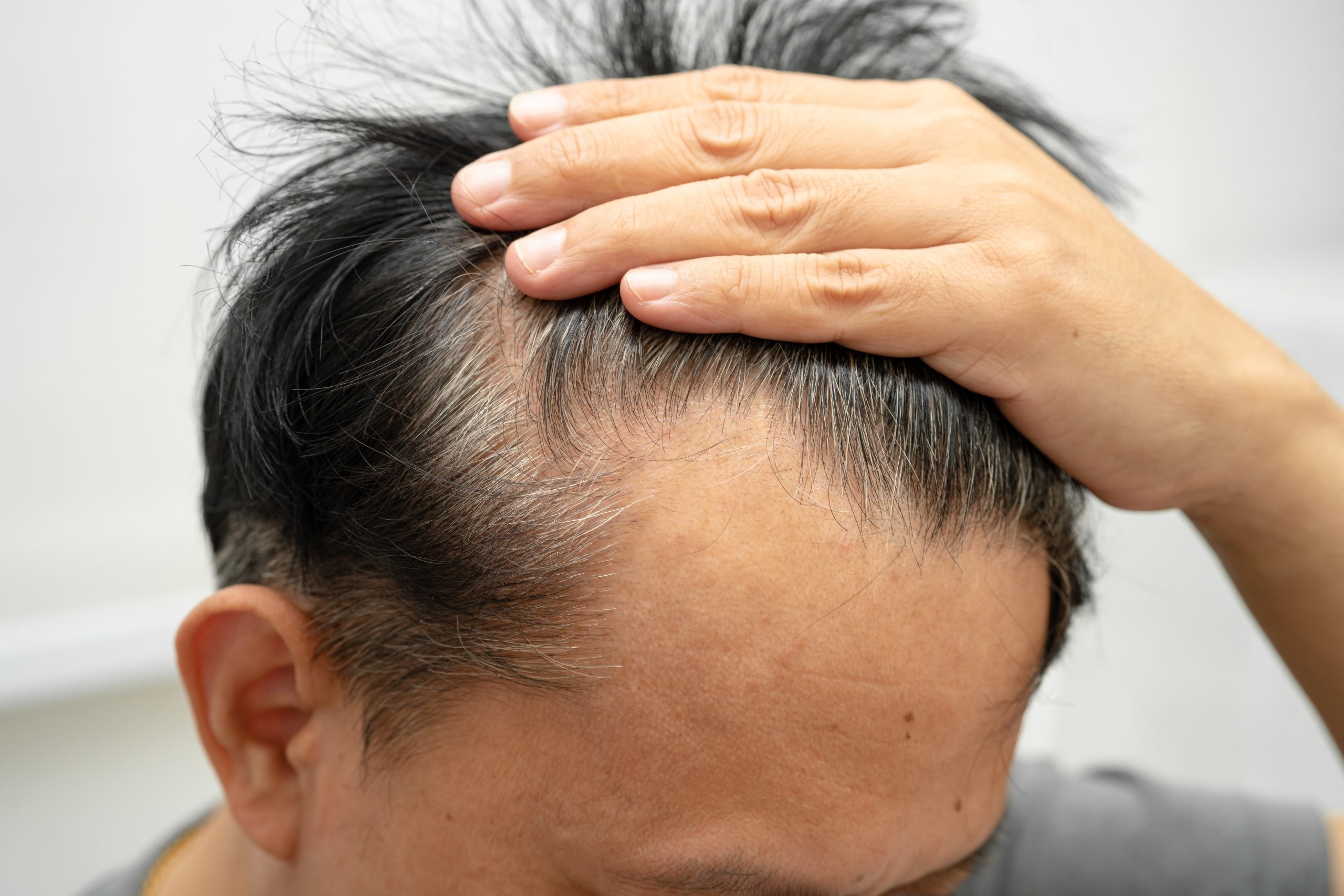 Person's hand touching top of head revealing hair thinning at crown