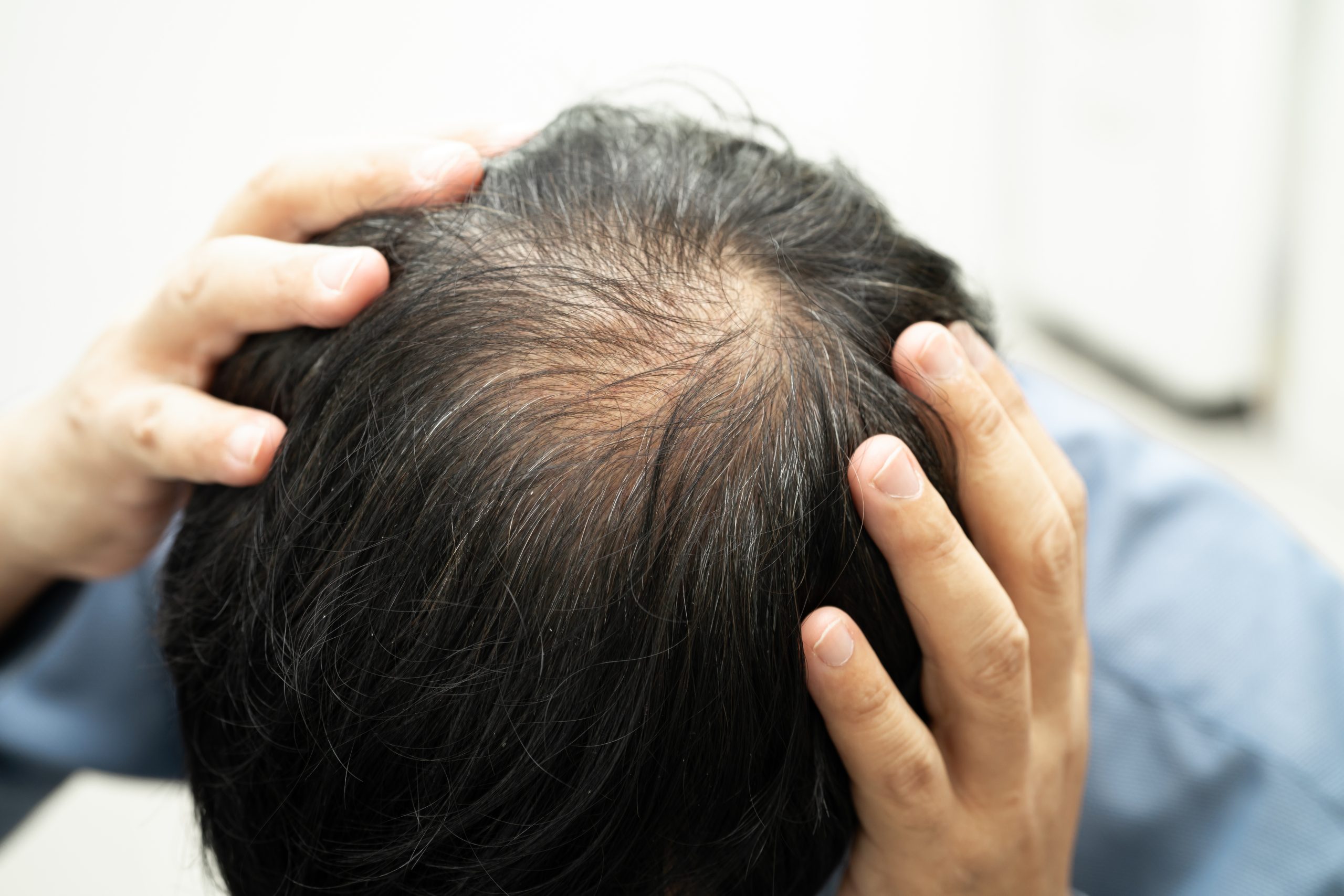 Hands examining crown area showing thinning hair and scalp visibility