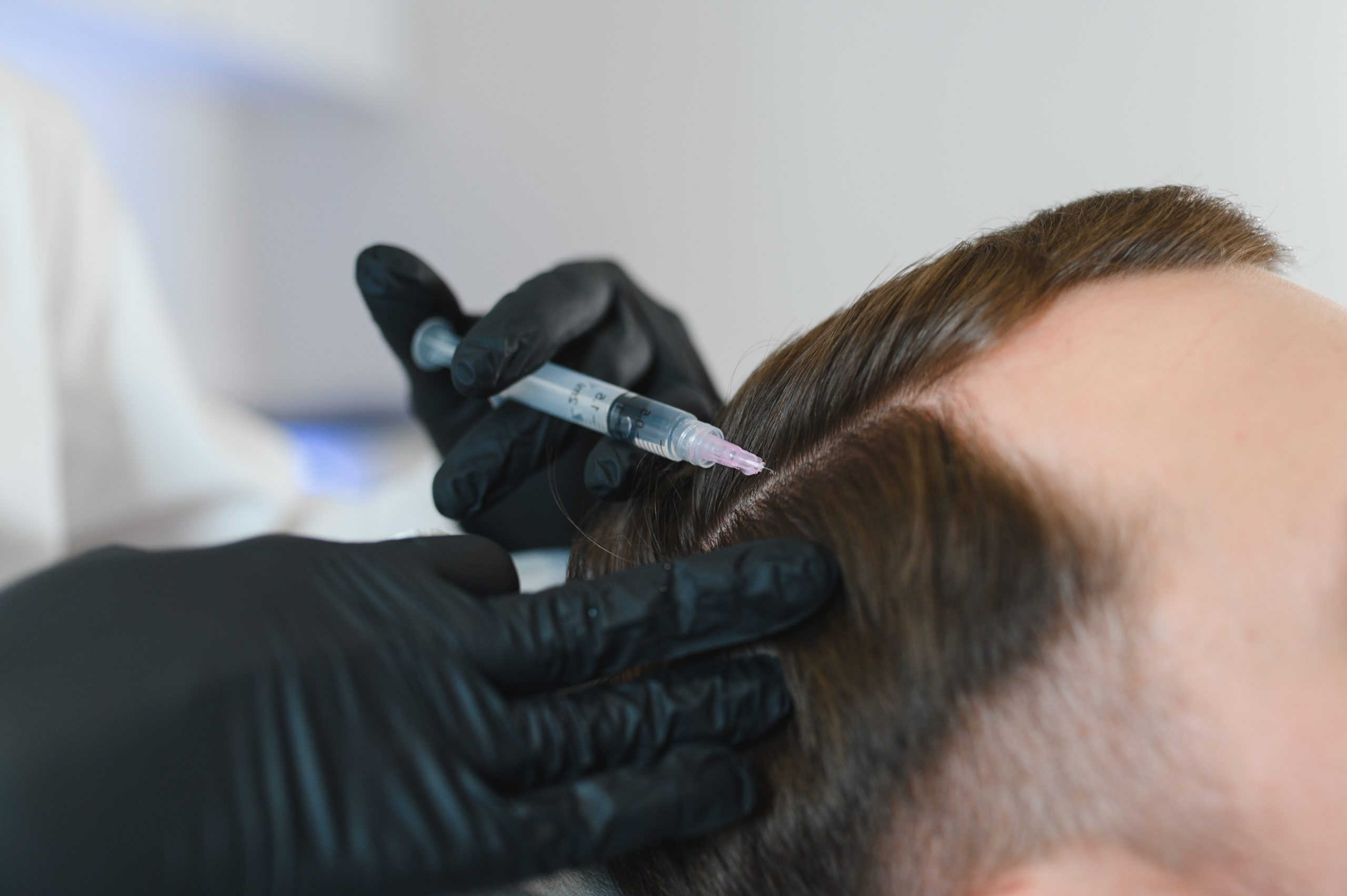 Practitioner in black gloves injecting treatment into patient's scalp near hairline