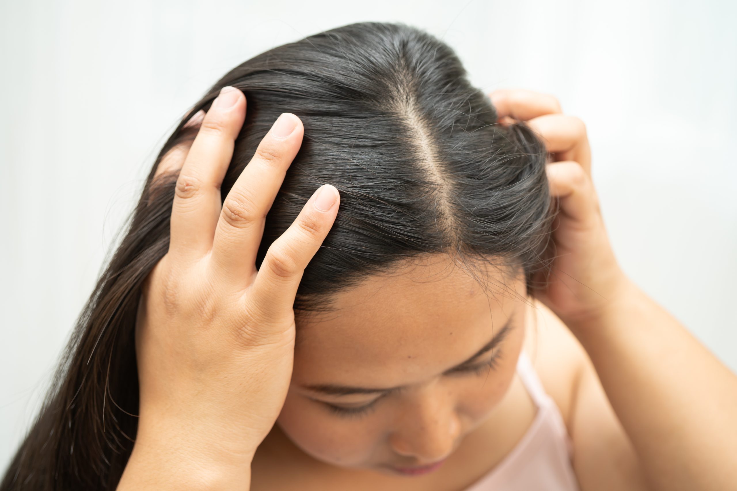 Woman touching scalp showing visible hair loss and exposed skin