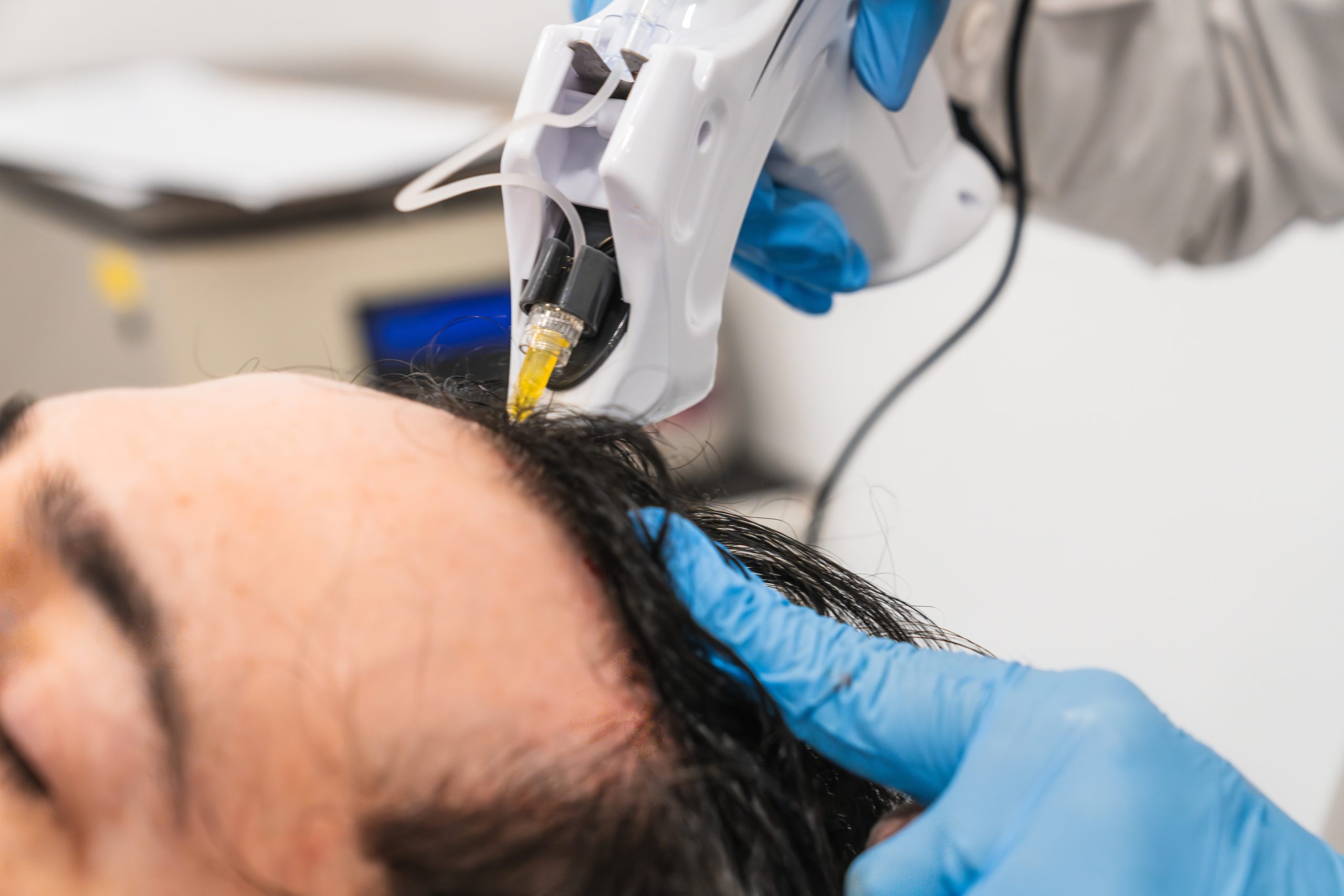 Practitioner in blue gloves using white and black handheld device on patient's scalp
