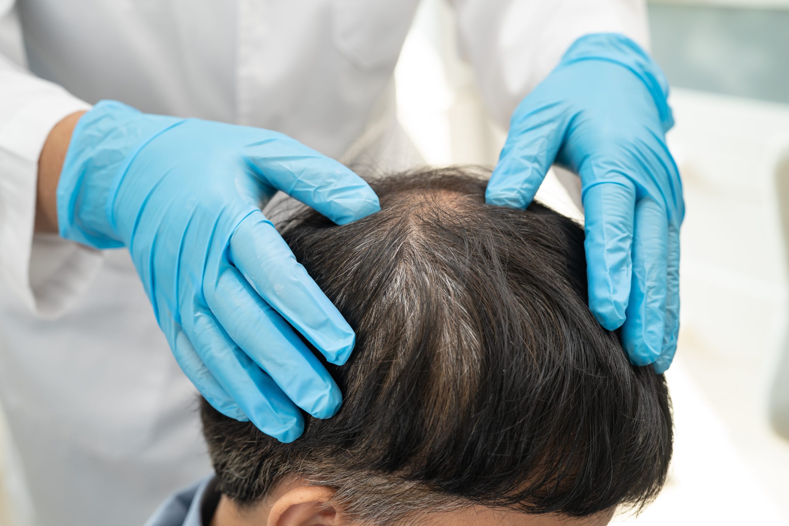 Clinician in blue gloves examining patient's scalp and hair at the crown