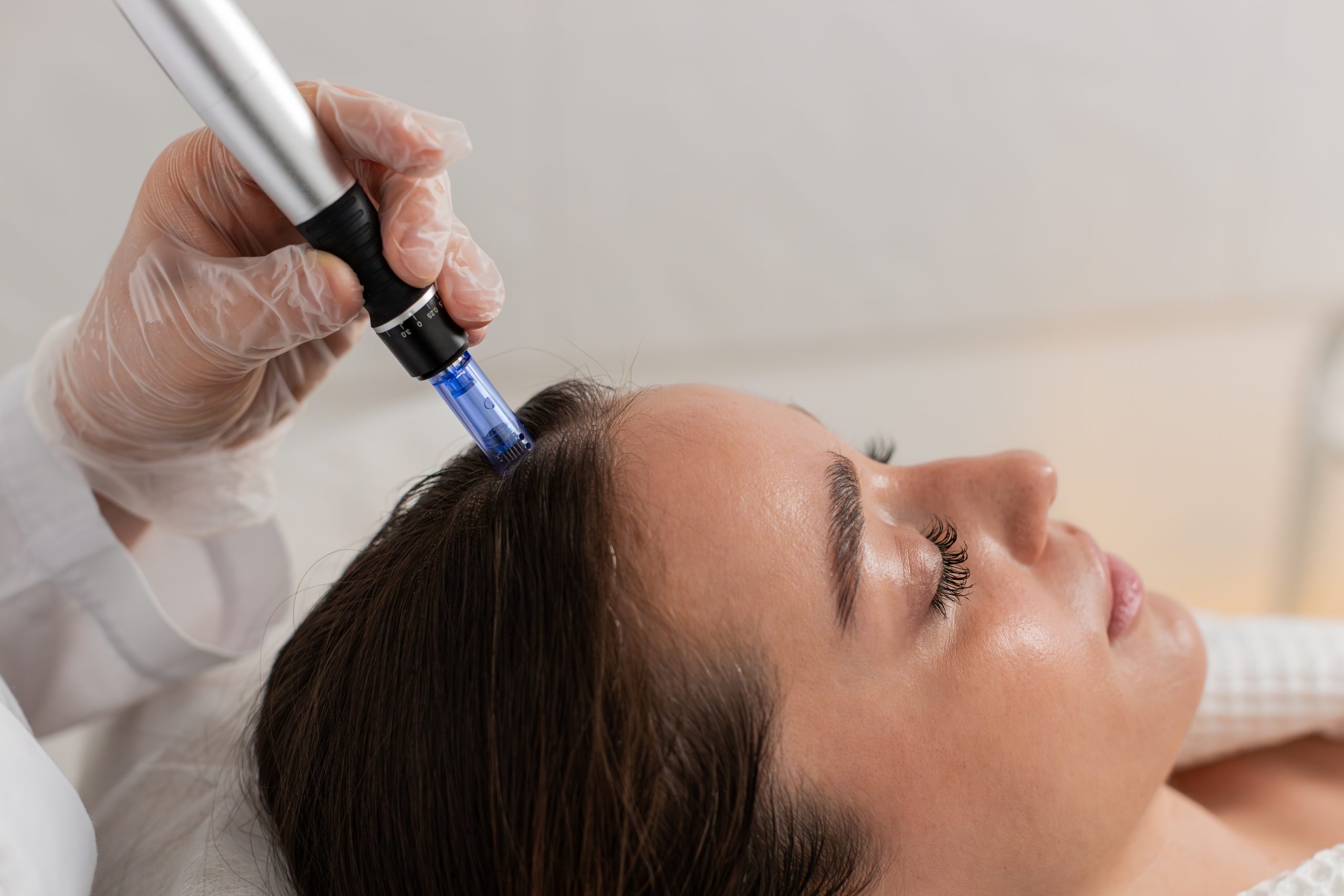 Clinician using microneedling pen on patient's scalp during treatment