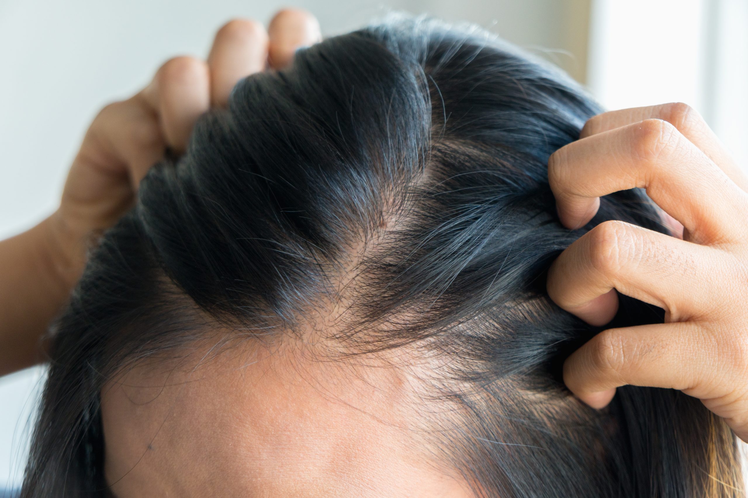 Person parting dark hair to reveal scalp with visible hair thinning