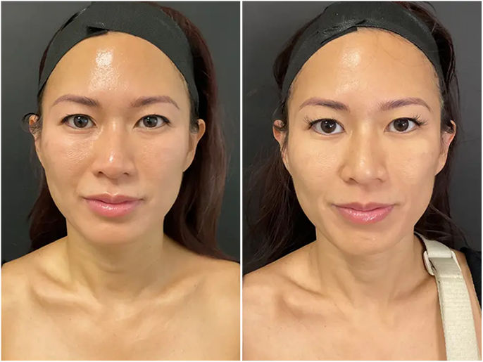 Before and after facial treatment showing improved skin texture and reduced puffiness