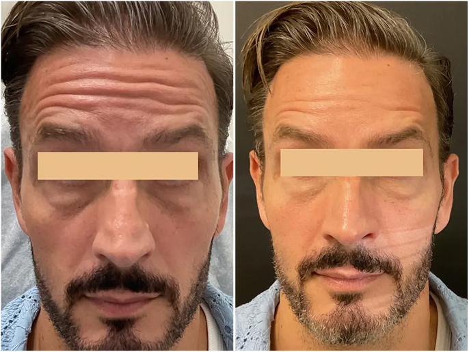 Before and after facial comparison showing reduced forehead wrinkles and improved skin appearance