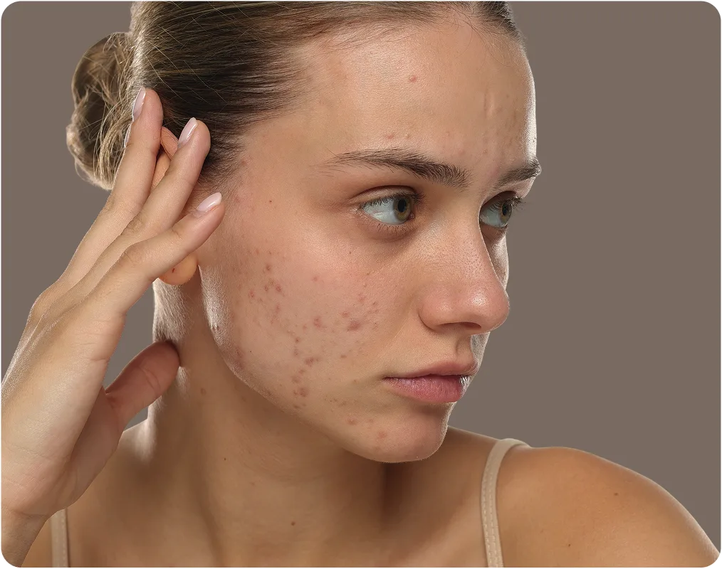 Woman with acne on her cheeks and forehead touching her face