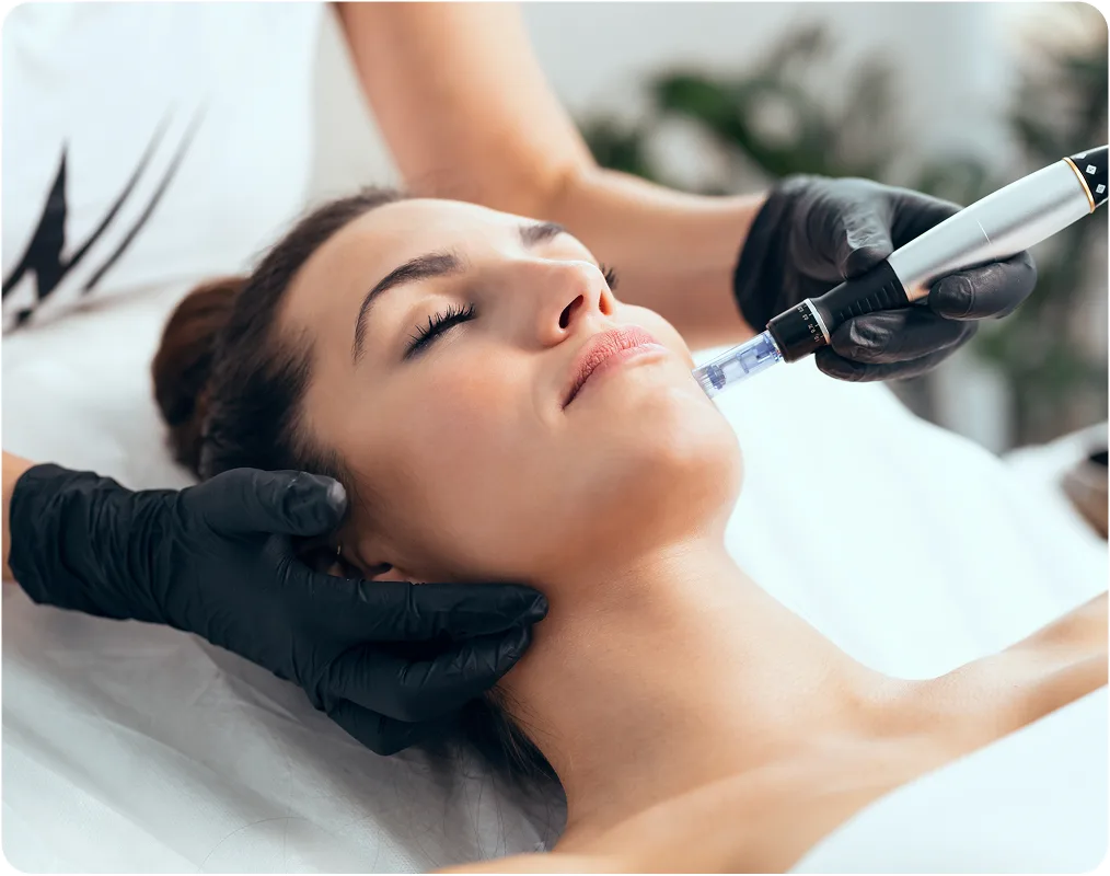 Practitioner performing microneedling treatment on a patient's cheek with a pen device
