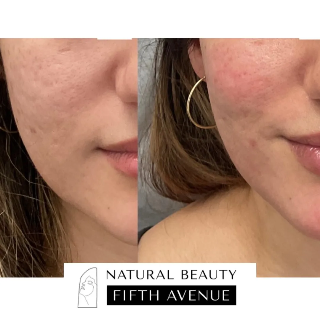 RF Microneedling + Subcision + Biostimulatory Injections before and after at Natural Beauty NYC (2 of 3)