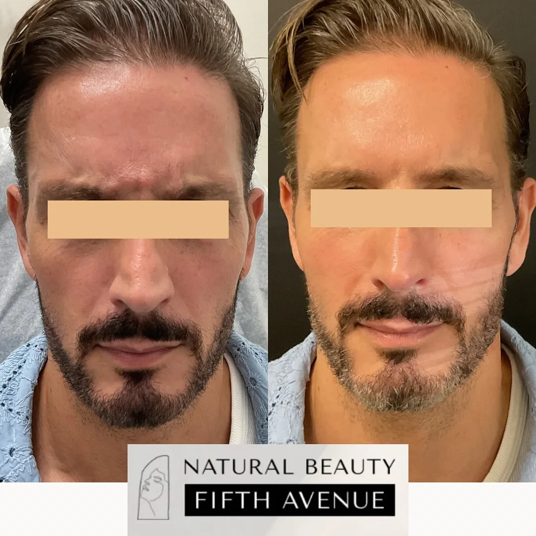Neurotoxin Case 3 before and after at Natural Beauty NYC (2 of 3)