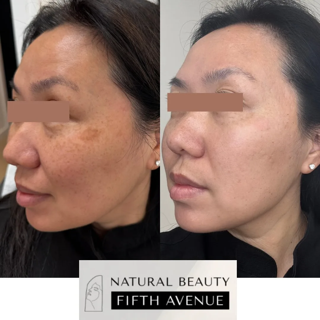 IPL Case 3 before and after at Natural Beauty NYC (2 of 3)
