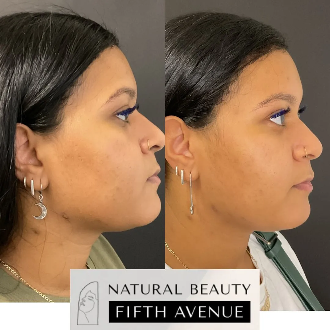 Chemical Peel Case 3 before and after at Natural Beauty NYC (2 of 3)