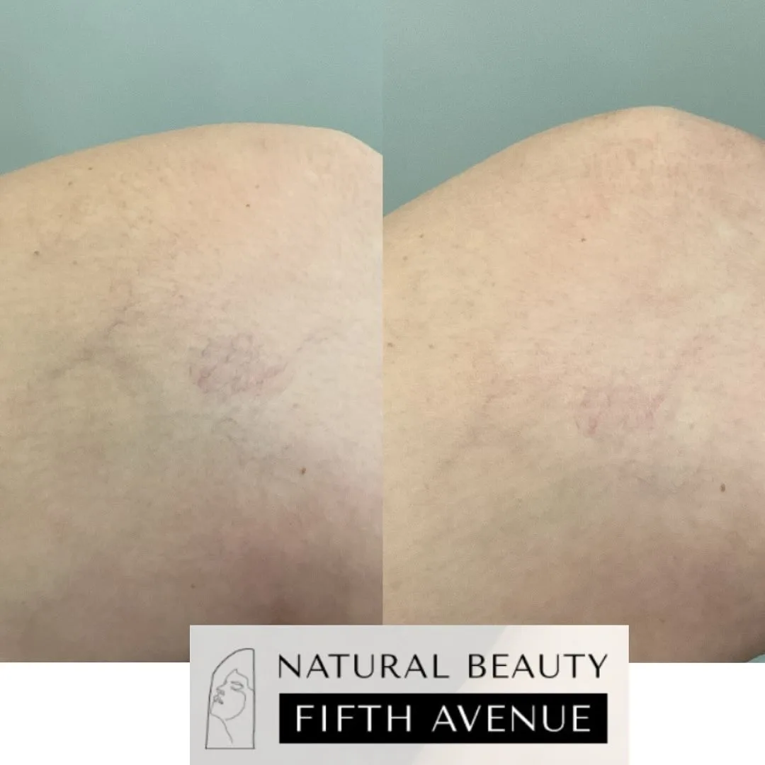 Candela Nordlys NdYAG 1064 before and after