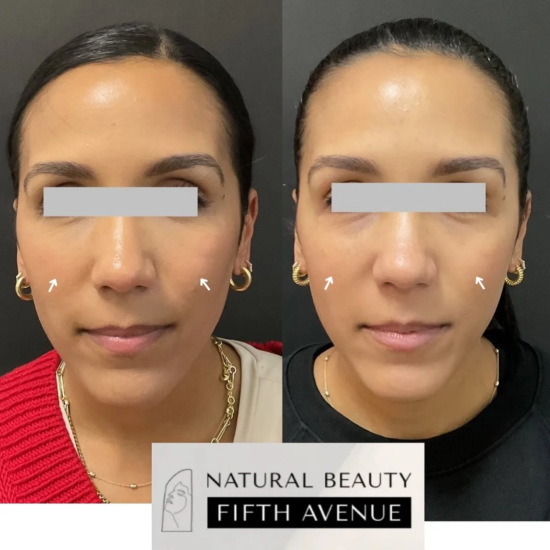 Dermal Filler Case 6 before and after at Natural Beauty NYC (2 of 4)