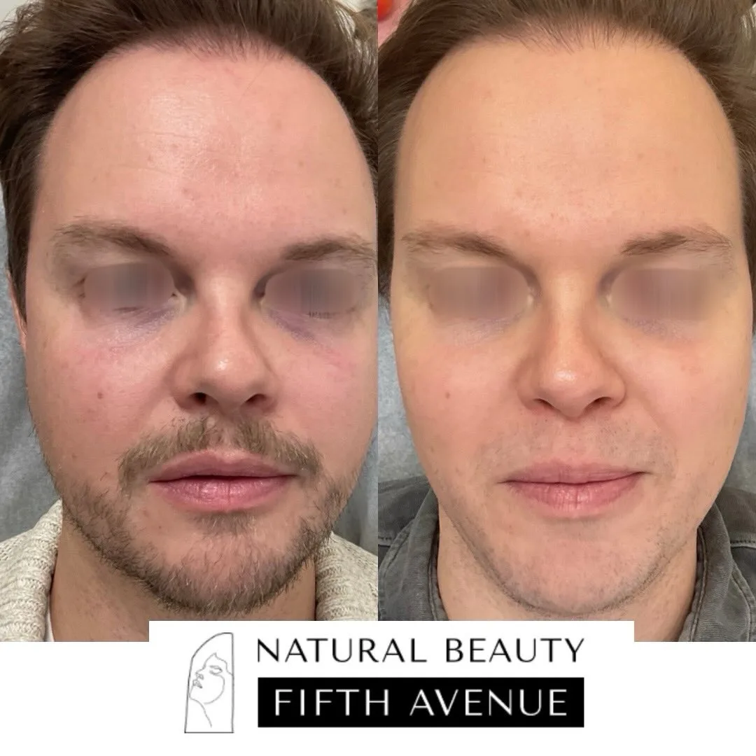 IPL,  Rejuran, Microneedling and Wrinkle Relaxer before and after at Natural Beauty NYC (2 of 2)