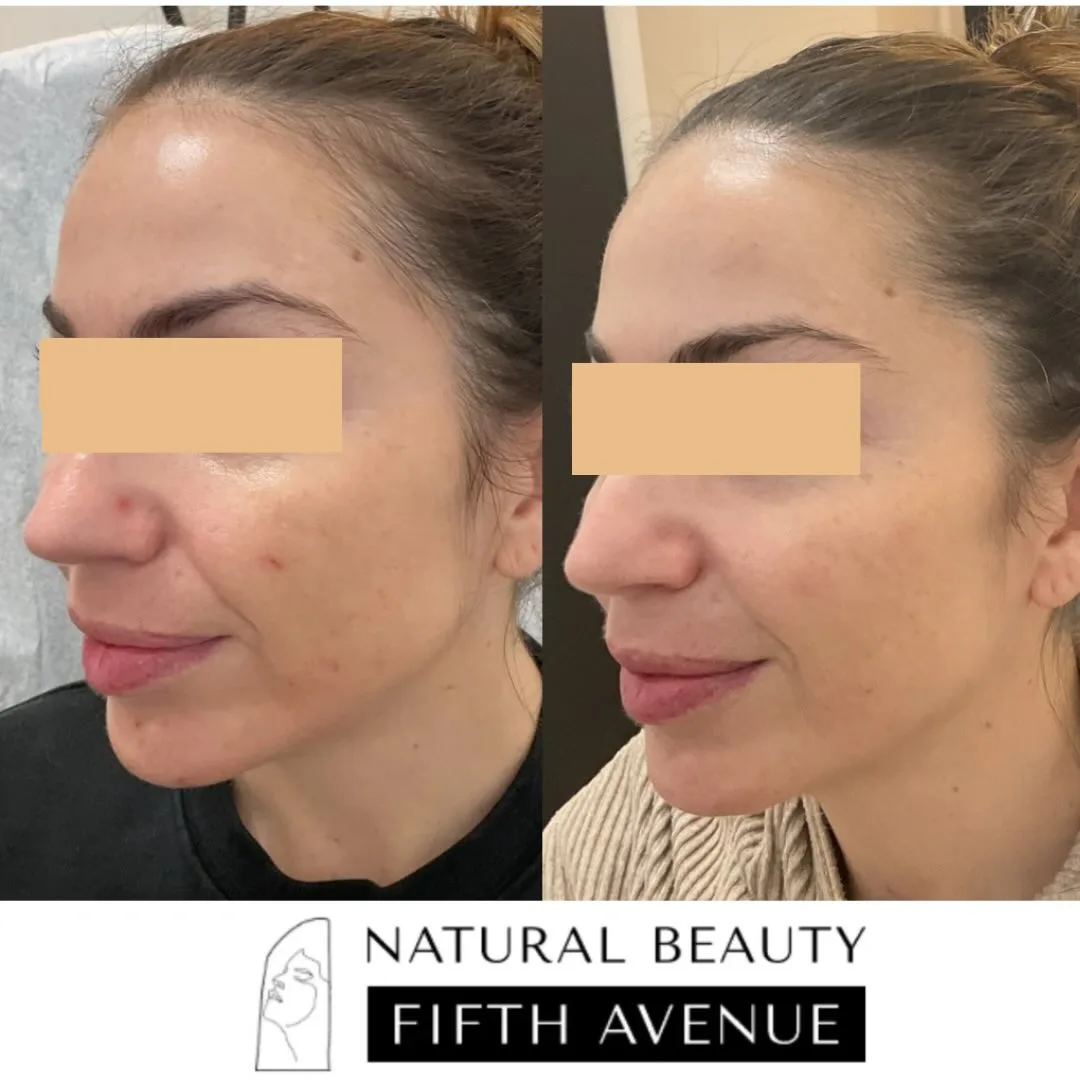 Radiesse Case 3 before and after at Natural Beauty NYC (2 of 3)
