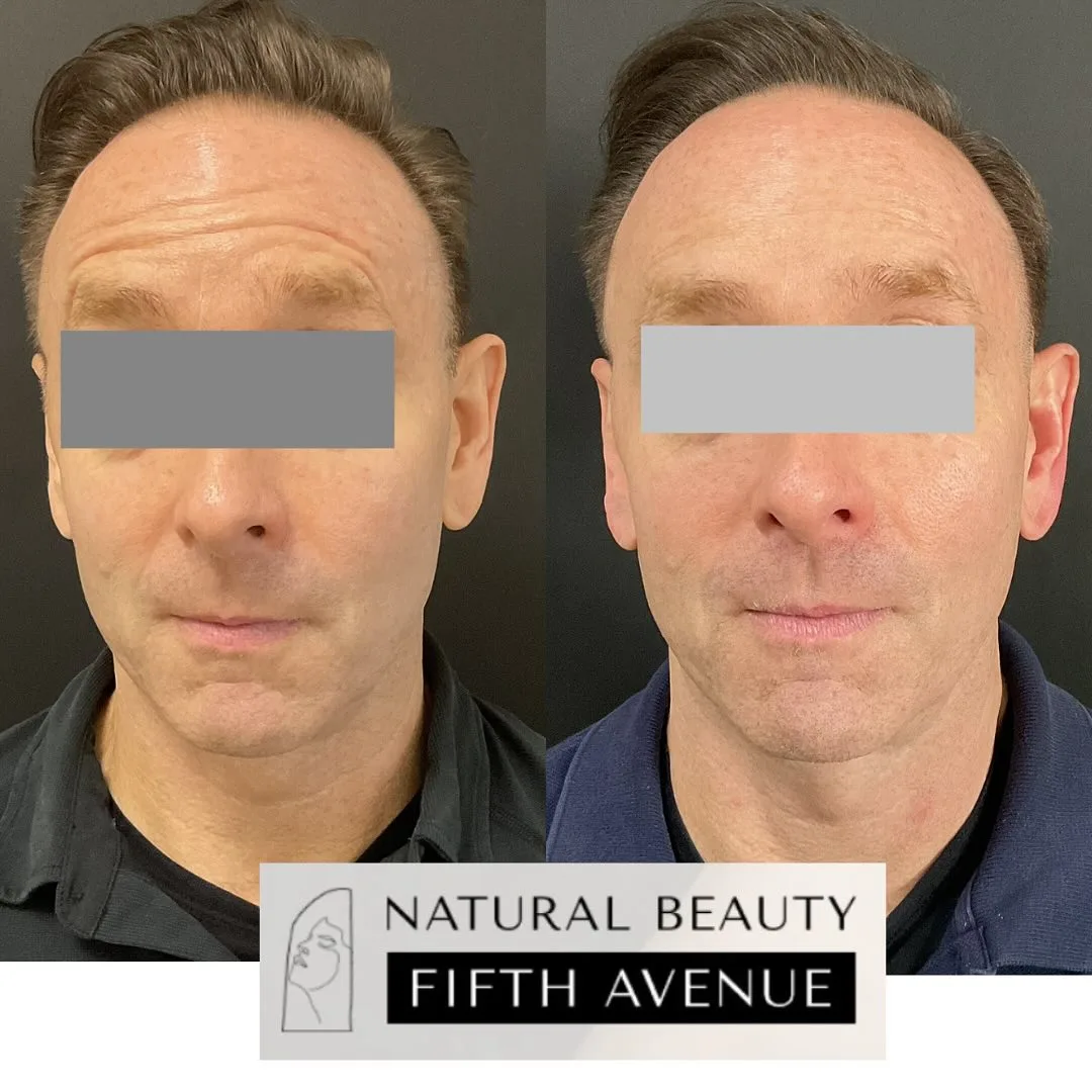 Injectables - Case 1 before and after