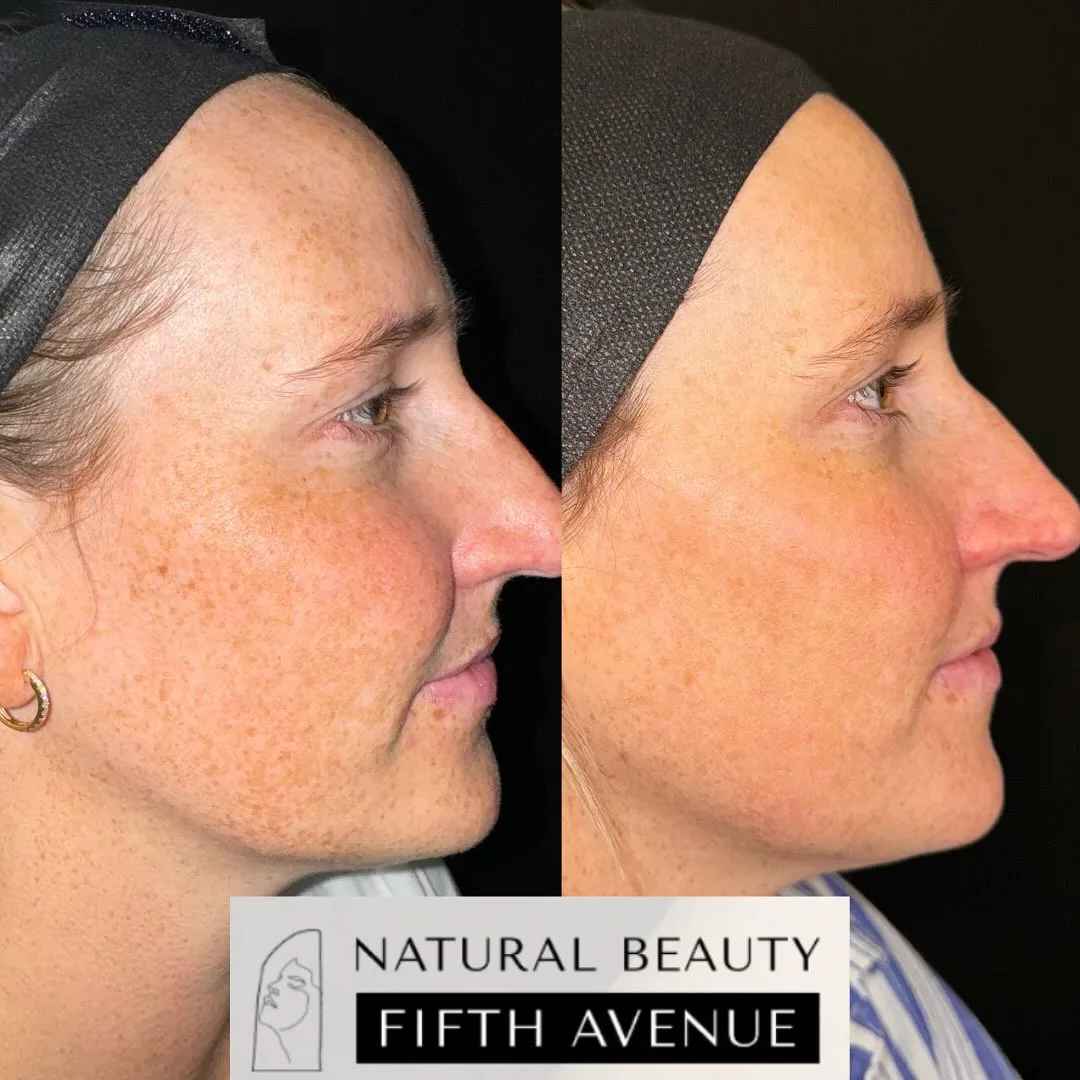 IPL Case 1 before and after at Natural Beauty NYC (4 of 5)