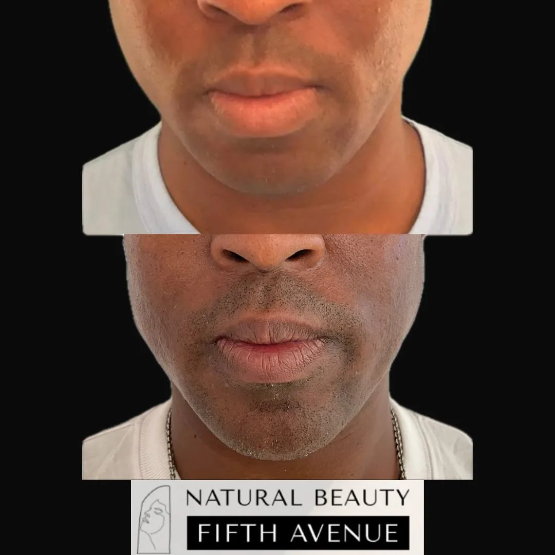 Jawline and Chin Filler before and after at Natural Beauty NYC (2 of 2)