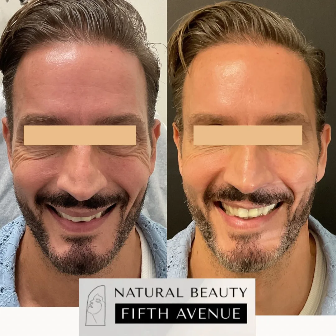 Neurotoxin Case 3 before and after