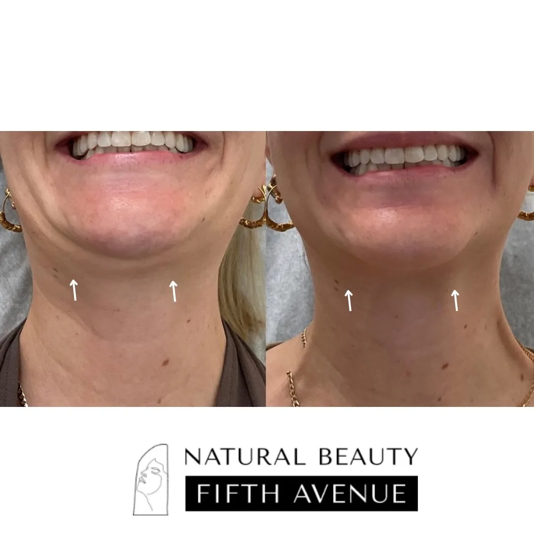 Nefertiti Lift Case 1 before and after at Natural Beauty NYC (2 of 3)
