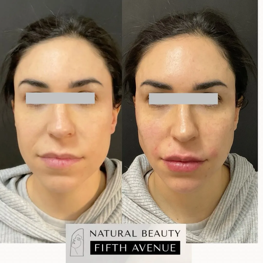 Dermal Fillers Case 2 before and after