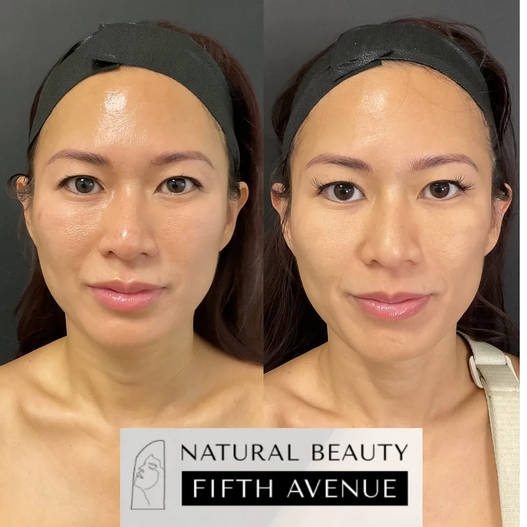 RF Microneedling Case 1 before and after at Natural Beauty NYC (3 of 4)