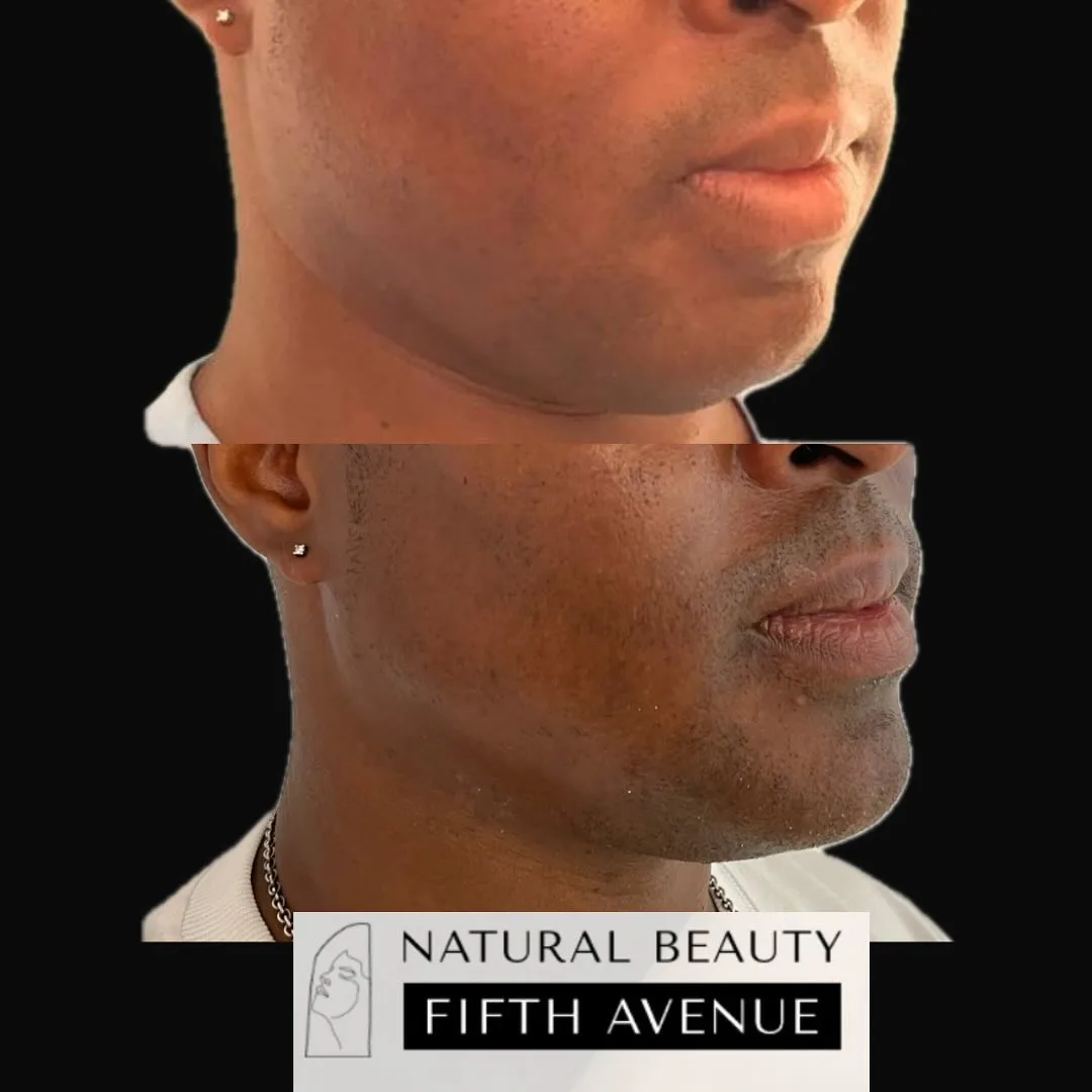 Jawline and Chin Filler before and after
