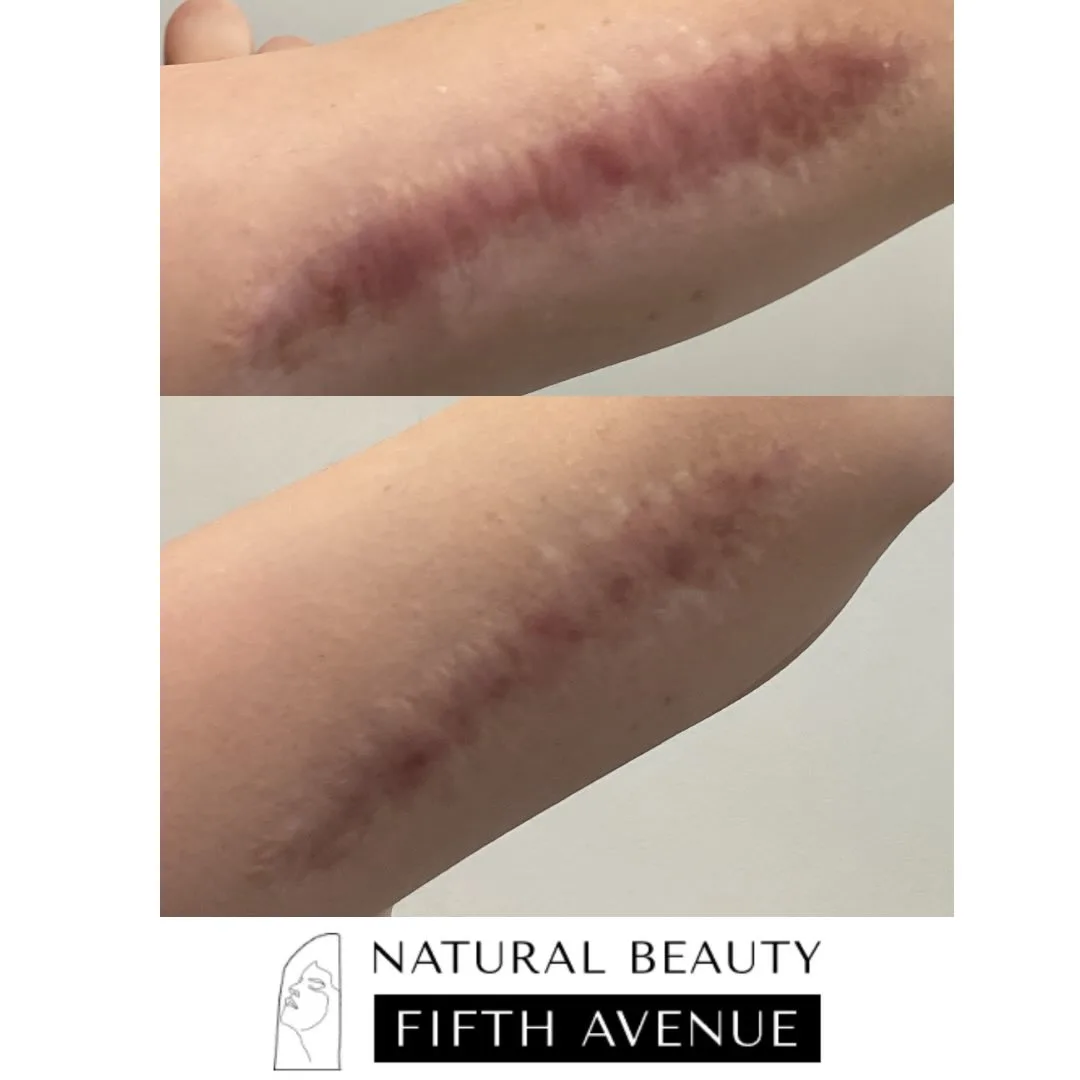 Surgical Scar Treatment before and after
