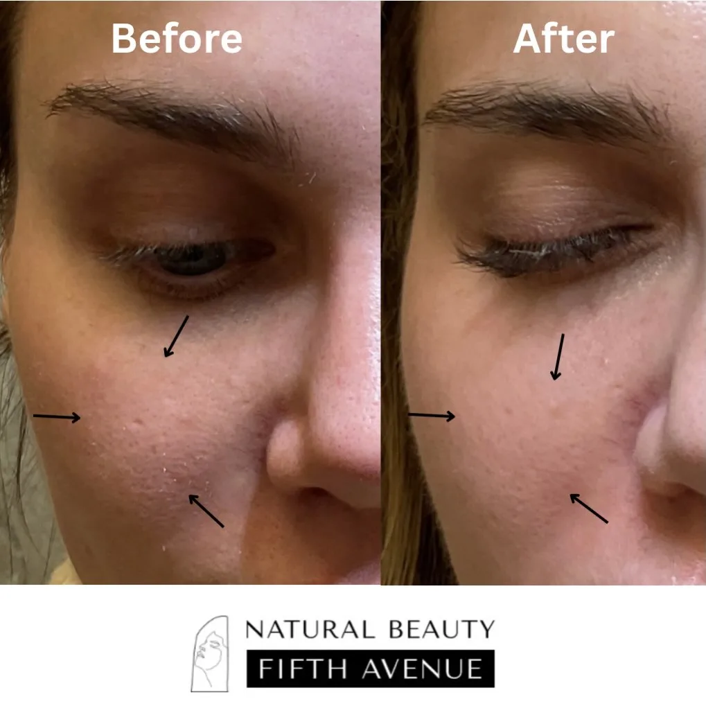 TCA CROSS and RF microneedling before and after