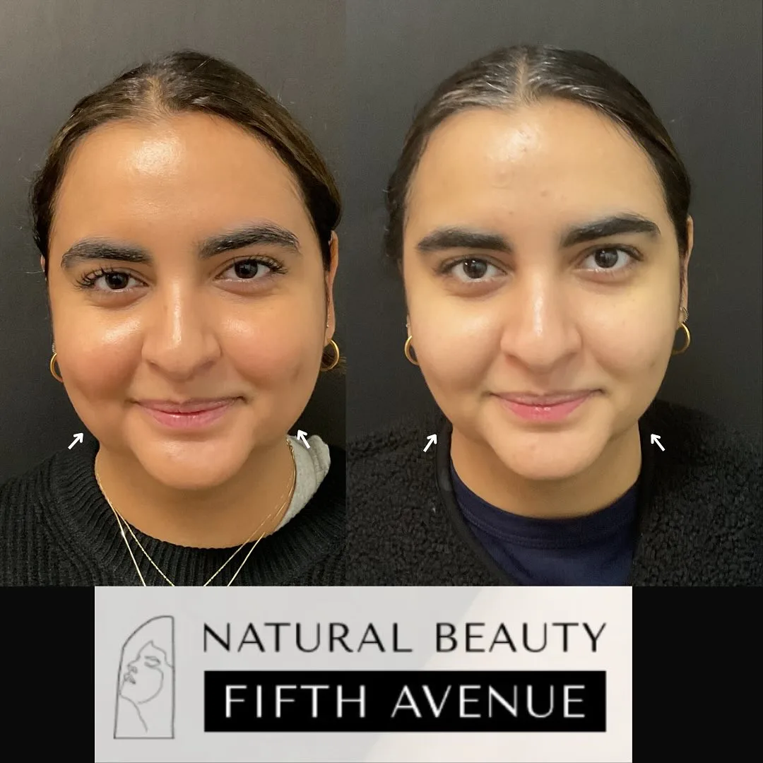 Masseter Botox before and after