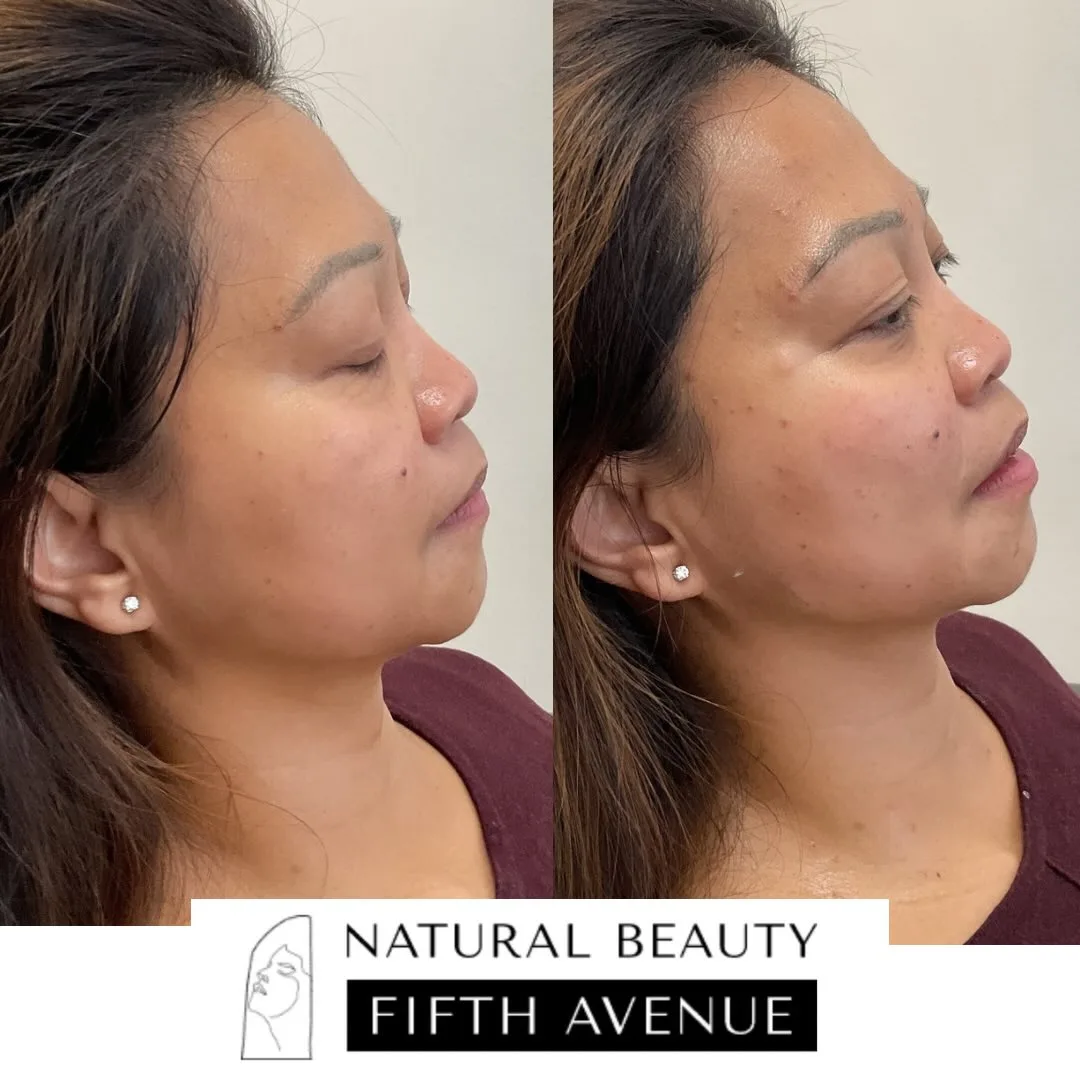 Radiesse Case 2 before and after at Natural Beauty NYC (3 of 4)