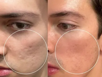 Laser Resurfacing before and after at Natural Beauty NYC