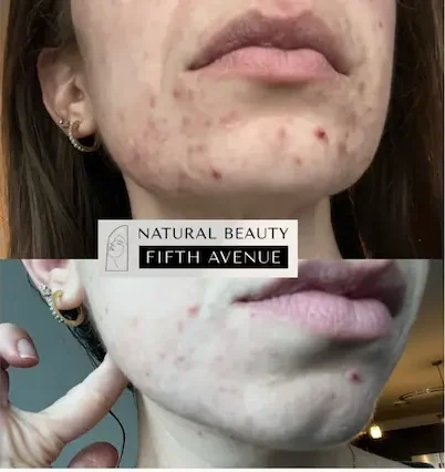 Acne Treatment before and after