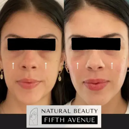 Under Eye and Cheek Filler before and after