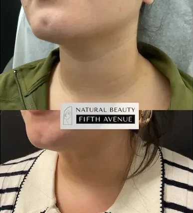 Tech Neck Dermal Filler before and after
