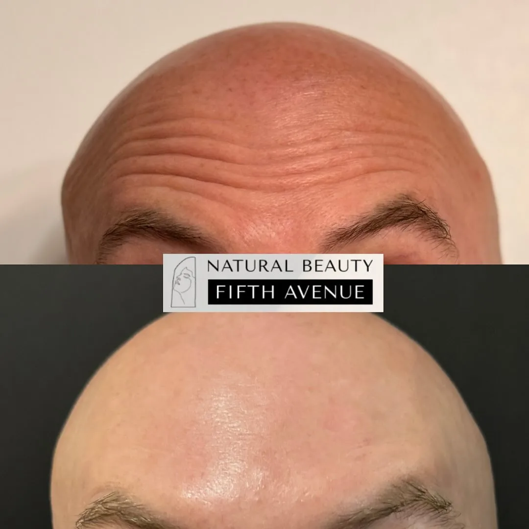 Injectables - Case 4 before and after