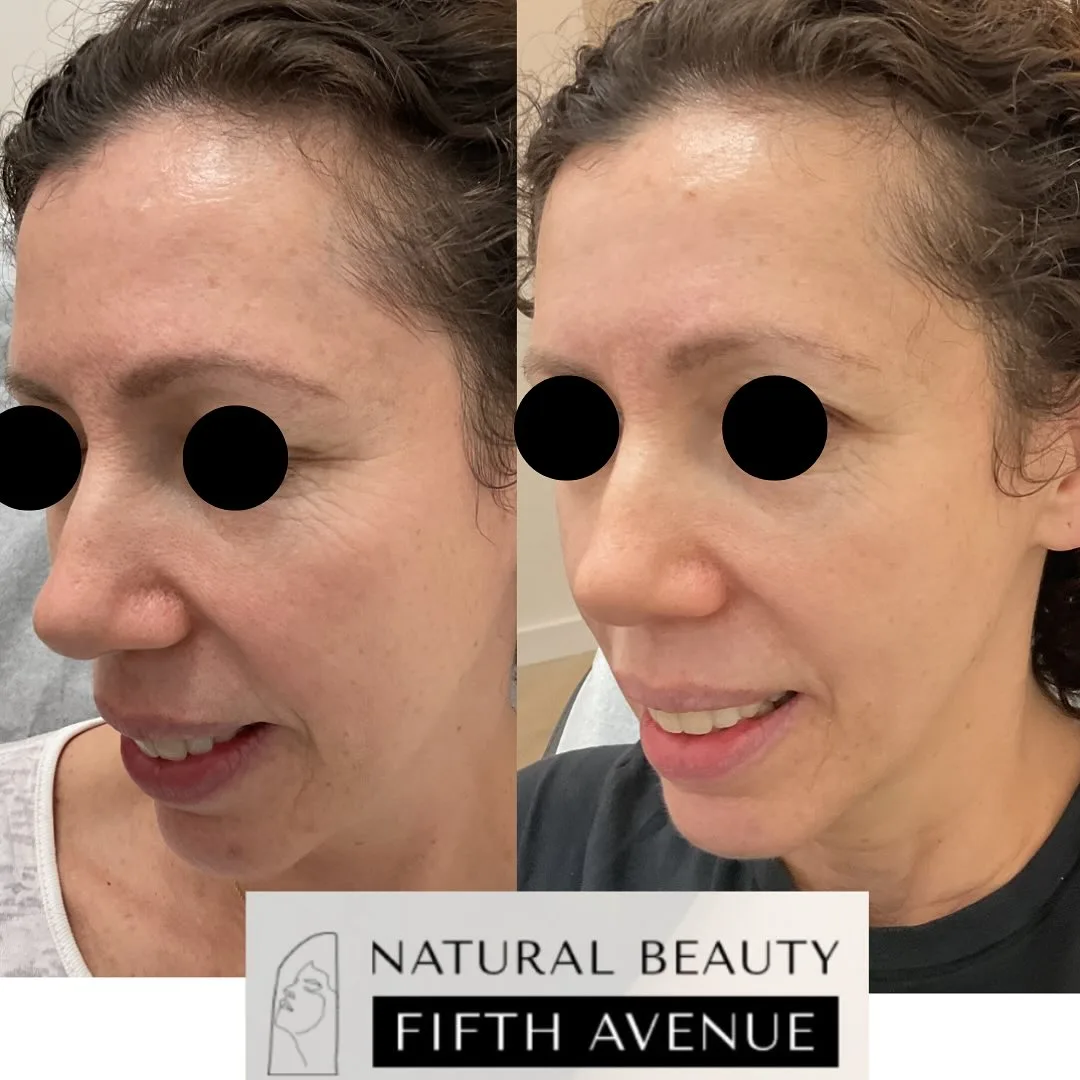 RF Microneedling with PRP Case 4 before and after at Natural Beauty NYC (3 of 3)