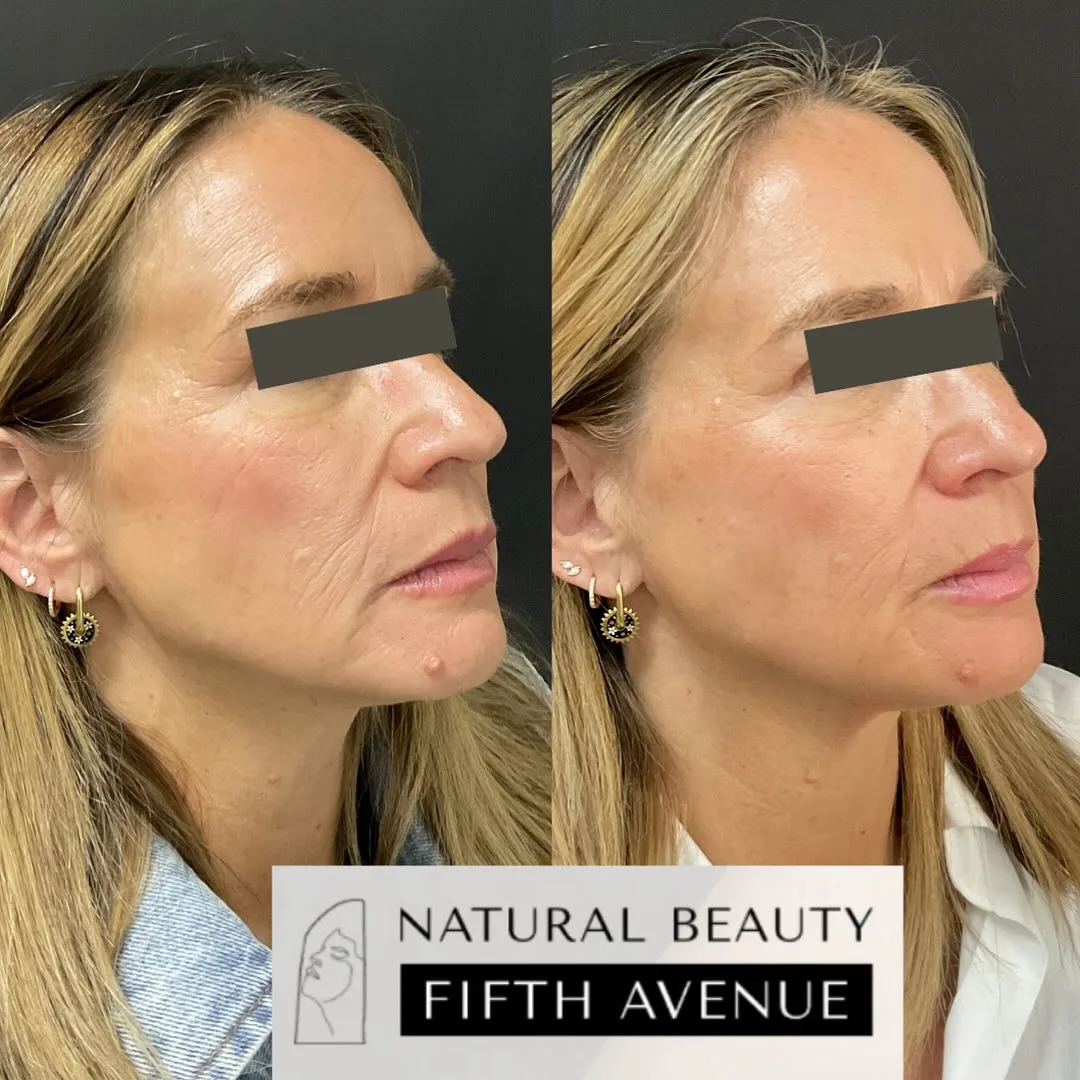 Sculptra Case 2 before and after at Natural Beauty NYC