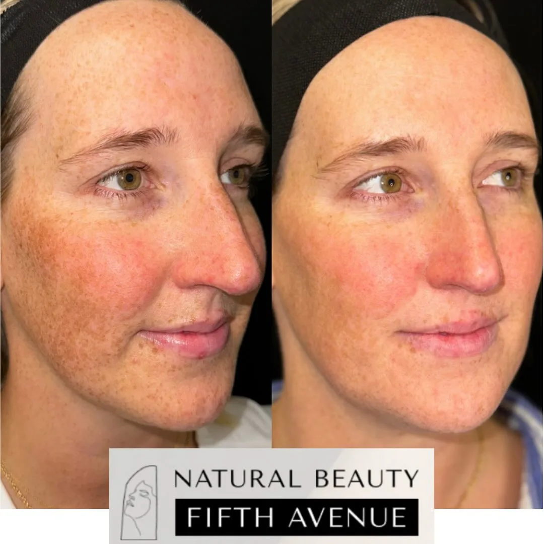 IPL Case 1 before and after at Natural Beauty NYC (5 of 5)