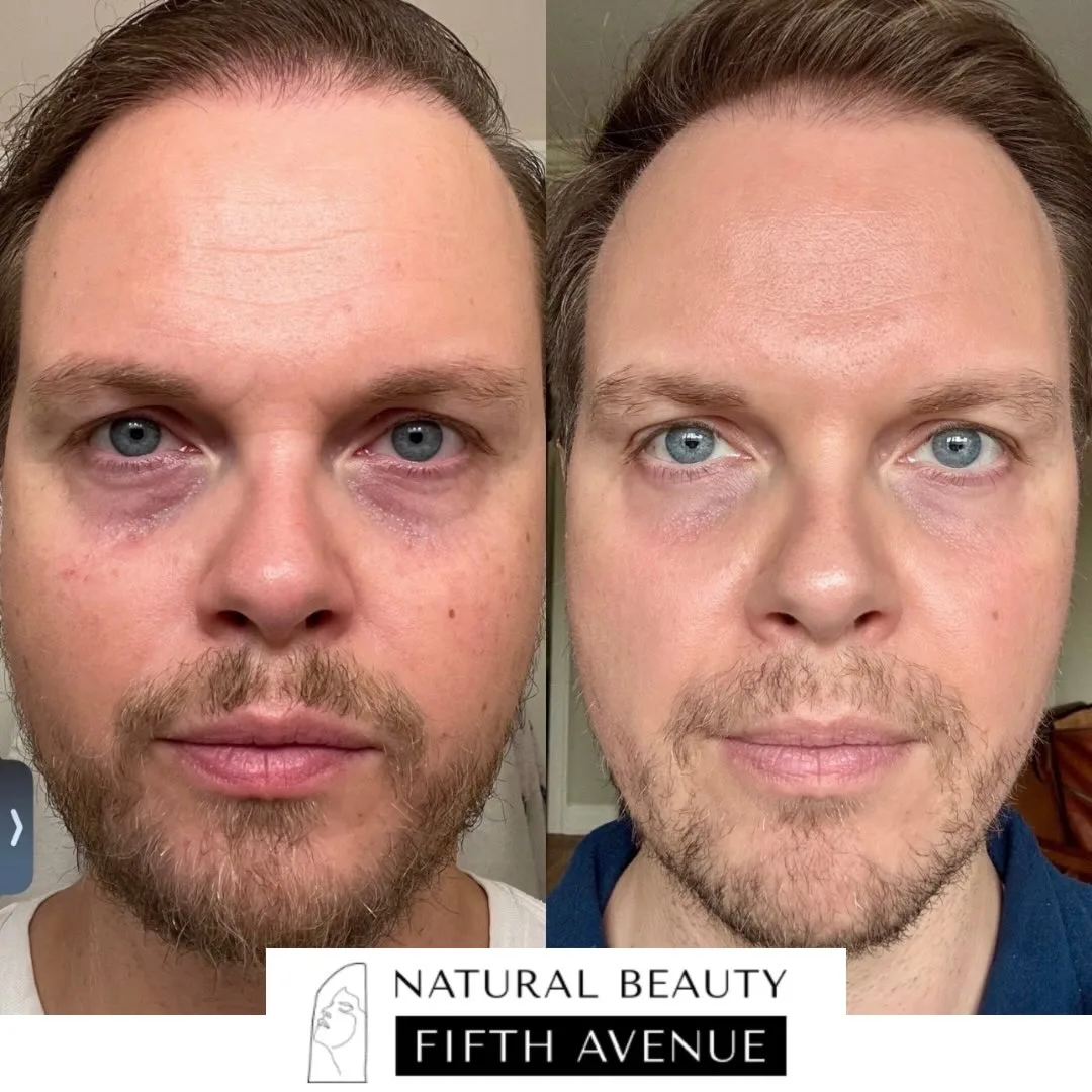 IPL,  Rejuran, Microneedling and Wrinkle Relaxer before and after