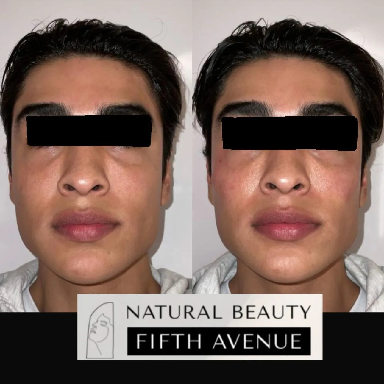 Dermal Filler Case 3 before and after at Natural Beauty NYC (2 of 2)